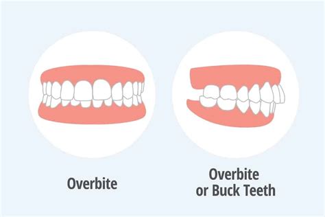 Overbite vs Normal Bite: Differences, Causes, and Treatment