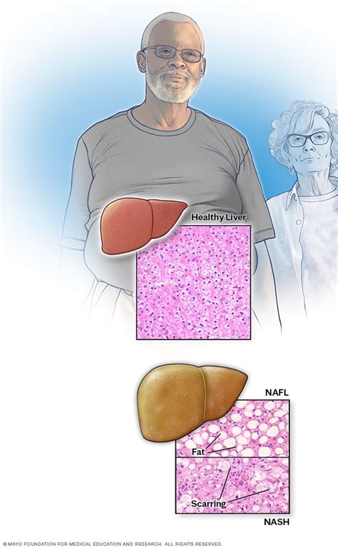 Nonalcoholic fatty liver disease - Symptoms and causes - Mayo Clinic