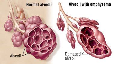 Emphysema Guide: Causes, Symptoms and Treatment Options