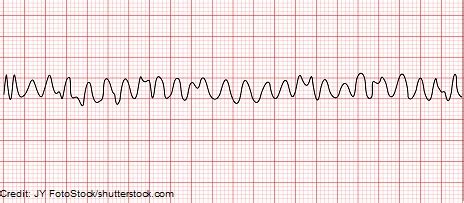 Ventricular Fibrillation (V-fib) Quiz Questions ECG/EKG