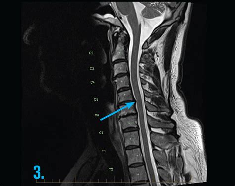 mri-cervical-spine-radiculopathy-gp-series - MRI at Melbourne Radiology ...