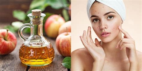 6 Home Remedies for Cystic Acne That Work | YouBeauty