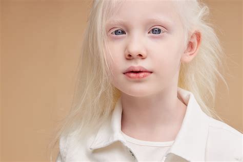 Albino Eye Color: Understanding Its Unique Appearance