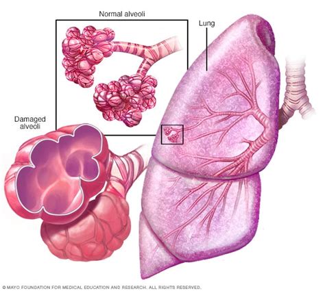 Emphysema - Symptoms and causes - Mayo Clinic