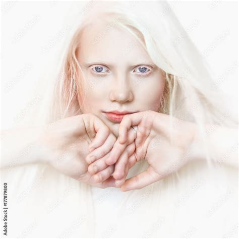 Albino girl with white skin, natural lips and white hair. Photo face on ...