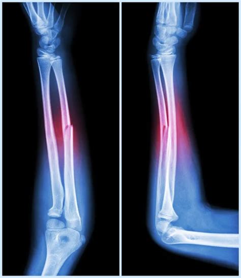 Fracture shaft of ulnar bone ( forearm bone ) : ( front and side view )