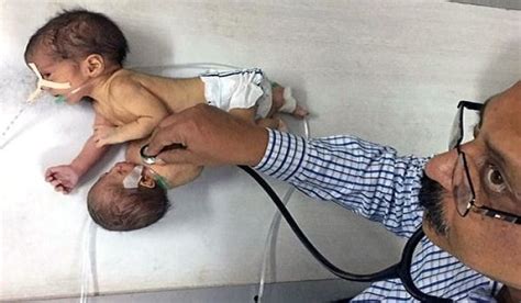 Baby Born with Parasitic TWIN Attached to his Chest » Financial Watch