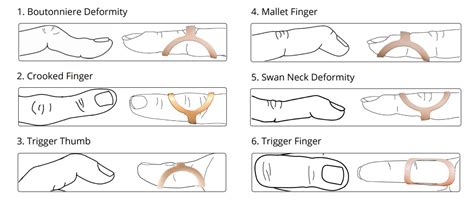 Oval-8 Finger Splint | Health and Care