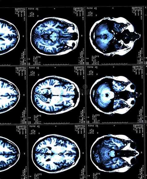 MRI Brain Scans of a Patient with Multiple Sclerosis Stock Image ...