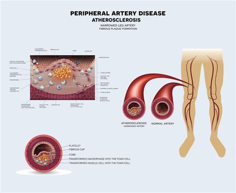 Peripheral artery disease treatment Perth | Dr Altaf