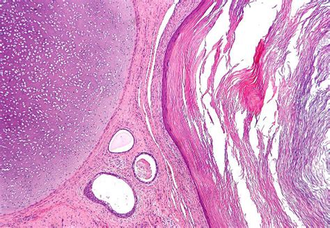 Most common type of teratoma of the testis is? - Surgery MCQ « PG Blazer