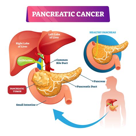 Pancreatic Cancer – The Cancer Foundation