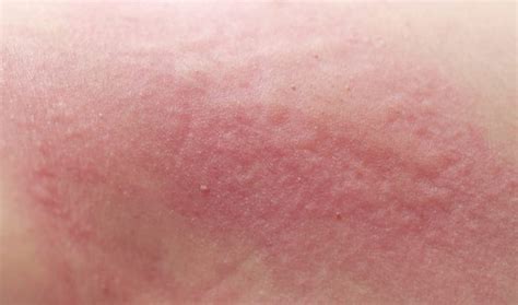 When to Worry about A Rash in Adults? - Healthella - Page 8