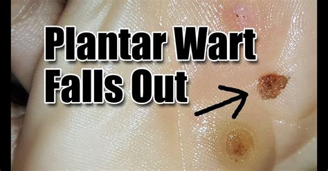 Stages Of Plantar Wart Removal - What Are the Different Stages of Wart ...