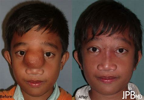 Craniofacial Surgery Before & After Photos | James P. Bradley, MD