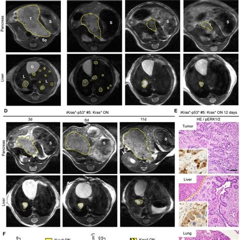 (A) Histology of a primary pancreatic adenocarcinoma and metastases to ...