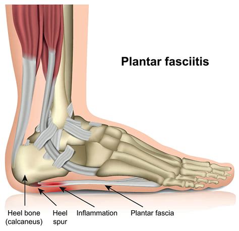 Plantar Fasciitis Heel Pain Treatment Online | bellvalefarms.com