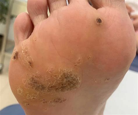 The What, Where, Why and How of Warts | The Footcare Clinic