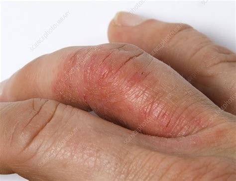 Psoriatic Arthritis on Hand - Stock Image - C036/6324 - Science Photo ...