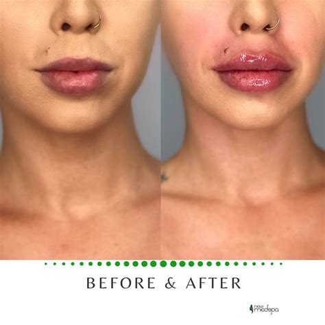 3Ml Lip Filler Before And After