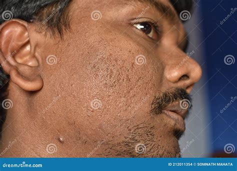 Close Up of Pimples Marks on Man`s Face . Deep Acne Scars on the Cheek ...