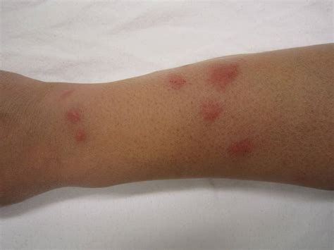 Bed bug bites symptoms - Bed Bug Treatment Site