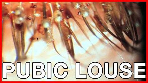 Crabs or Pubic Louse: Early Symptoms, Cure, Risks, Pictures - YouTube