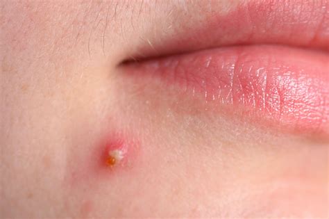 Acne - treatments, causes and prevention | healthdirect