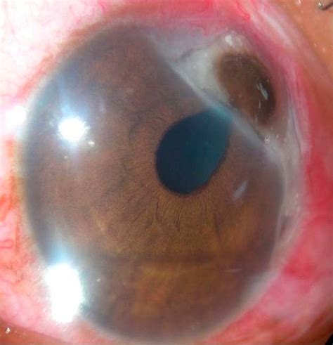 Large peripheral corneal perforation secondary to Mooren ulcer ...