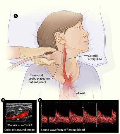 Vascular & Endovascular Surgery - Carotid Ultrasound