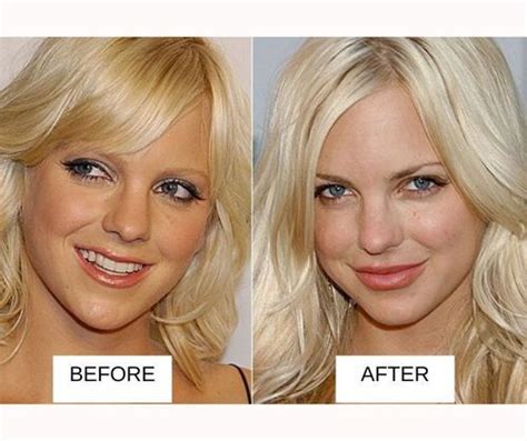 25 Most Popular Celebrities With Lip Fillers: Before And After With ...