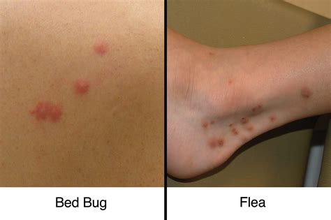 Do Bed Bug Bites Look Like Flea Bites - Pest Phobia