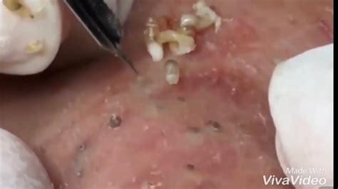 Dr Pimple Popper Blackhead Extraction Pops at William Frazier blog