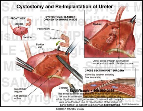 Cystostomy; Suprapubic Cystostomy; Vesicostomy