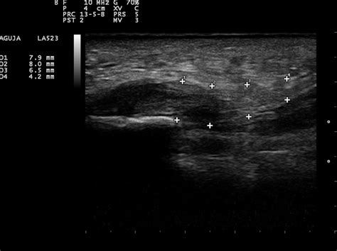 "Ultrasound-guided Plantar Fasciitis Surgery - Clínica del Pie La ...