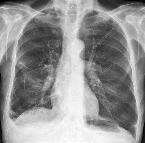 Emphysema Chest X Ray