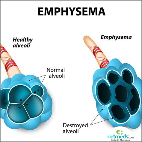 Emphysema: Causes, Symptoms And Treatment | Netmeds