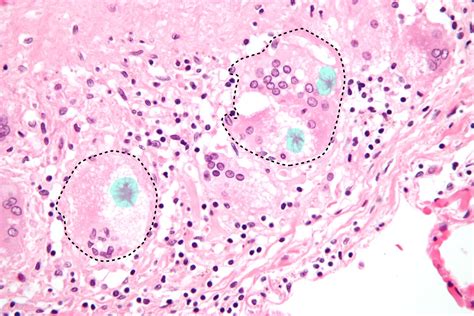 Lupus Pernio Histology