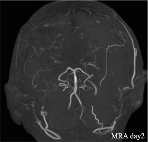 Magnetic resonance angiography findings on days 2. MRA, magnetic ...