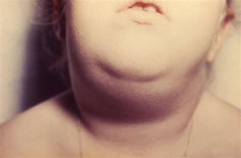 Mumps - Symptoms, What Mumps Look Like, Vaccine & Treatment