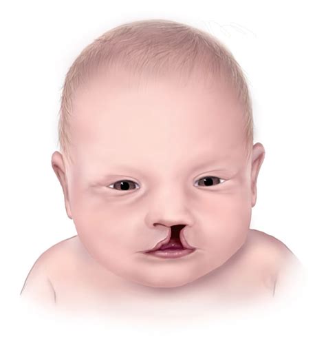 What are Cleft and Craniofacial Conditions? - AmeriDisability