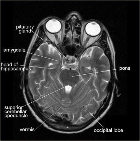 Ct Scan Brain Anatomy : Anatomy Of Head Ct Scan Normal The Brain On Ct ...