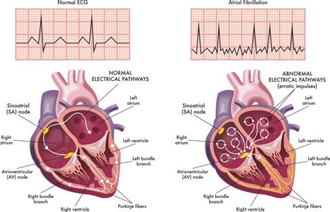 Atrial Fibrillation - About the Heart