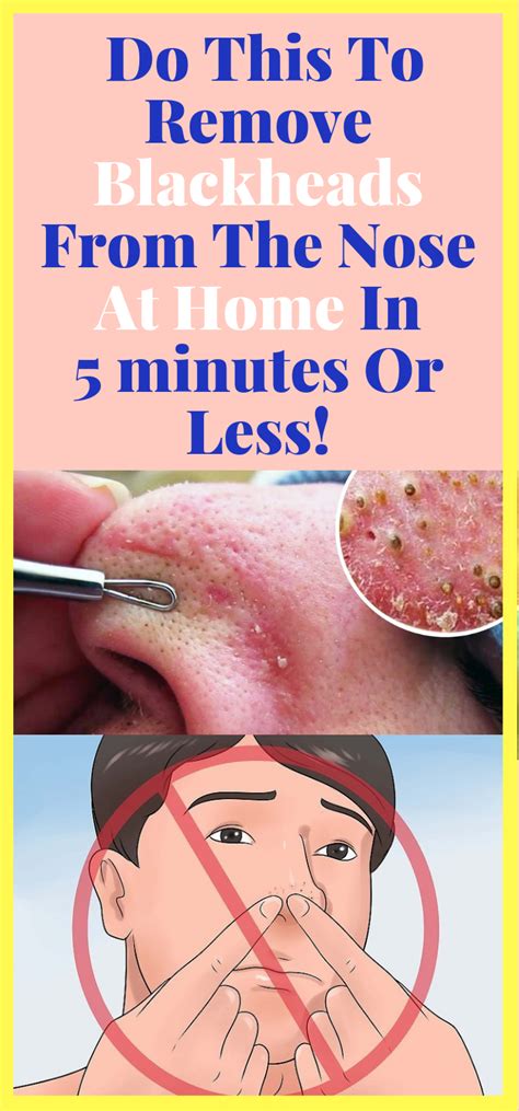 Daily Health Advisor : Do This To Remove Blackheads From The Nose At ...