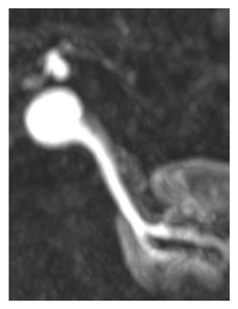 Contrast-enhanced magnetic resonance angiography (MRA) images of a ...