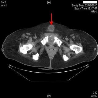 (PDF) Preventable long-term complications of suprapubic cystostomy ...