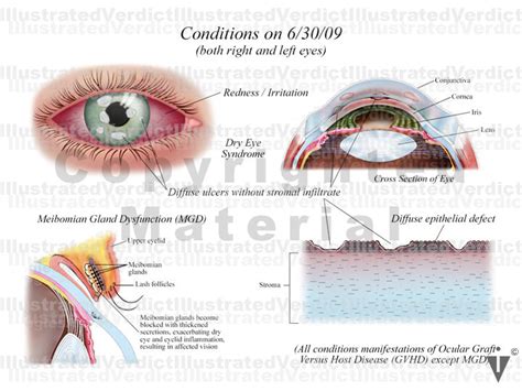 CASE AT A GLANCE: Corneal Perforation / Corneal Transplant ...