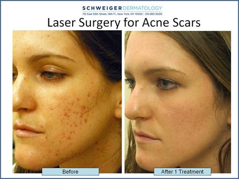 How to Treat Deep Pitted Acne Scars, Fractional CO2 Laser for Scars