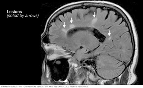 Multiple sclerosis MRI scan - Mayo Clinic