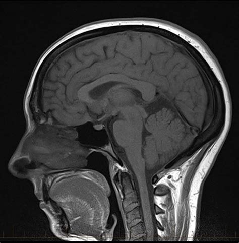 Mri Images Of The Brain